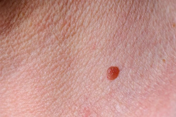 Be Skin Smart This Summer